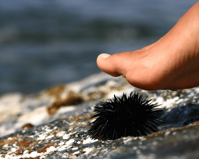foot stepping on a sea urchin