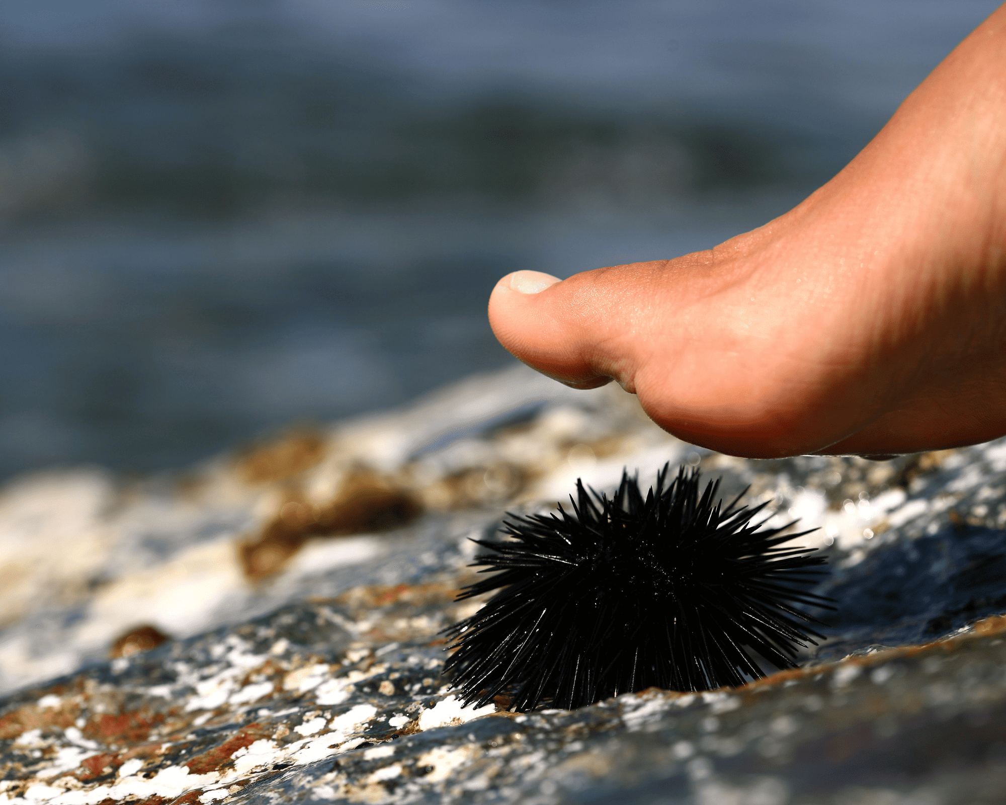 Sea Urchin in Foot What You Should Know